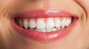 Close-up of a perfect white smile after professional teeth whitening treatment